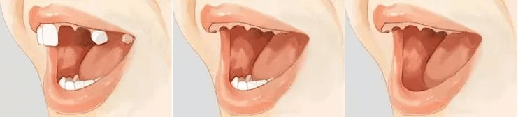 65岁缺牙苦 圣贝牙科种牙8颗，排骨、胡豆都敢吃了！